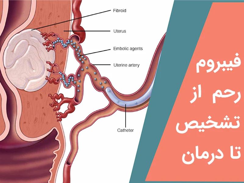 عکس فیبروم رحم