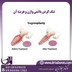 هزینه تنگ کردن دائمی واژن