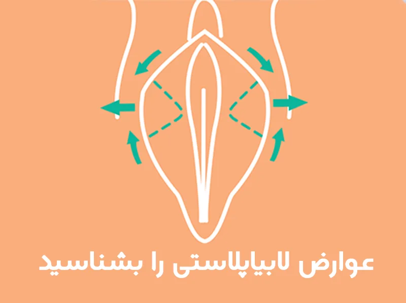 عوارض لابیاپلاستی