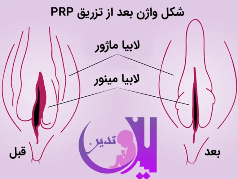 جوانسازی واژن با PRP
