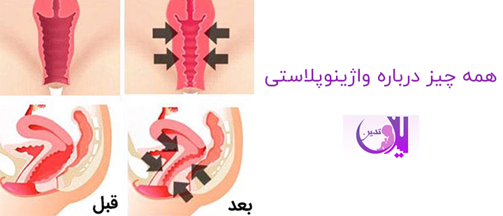 همه چیز درباره واژینوپلاستی