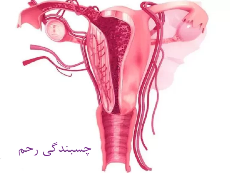 آشنایی با چسبندگی رحم