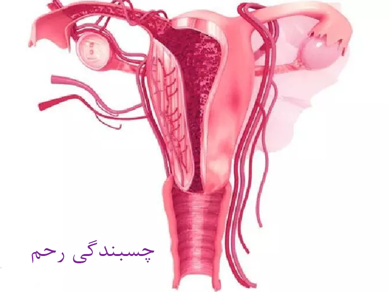 آشنایی با چسبندگی رحم